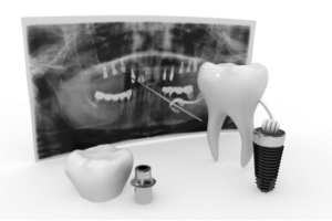 Premium Crown and Bridge Outsourcing Services using FDA-compliant Zirconia and e.max