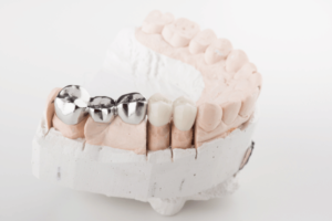 Digital RPD CAD Design Services for US dental labs and SLM metal printing