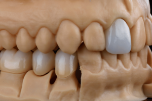 B2B Dental CAD Design Services using Exocad and 3Shape for US dental labs