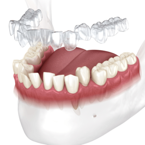 Pros and cons of clear aligner outsourcing versus in-house 3D printing for US dental clinics