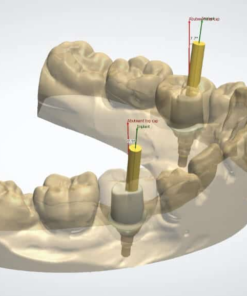 Custom Abutment CAD Design Service in native 3Shape and Exocad
