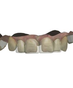 Digital Snap-on Smile CAD Design Service for removable veneers in Exocad