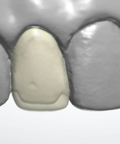 Digital Dental Veneer CAD Design Service for anterior aesthetics