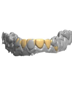 Digital Diagnostic Wax-up CAD Design and Smile Design in Exocad