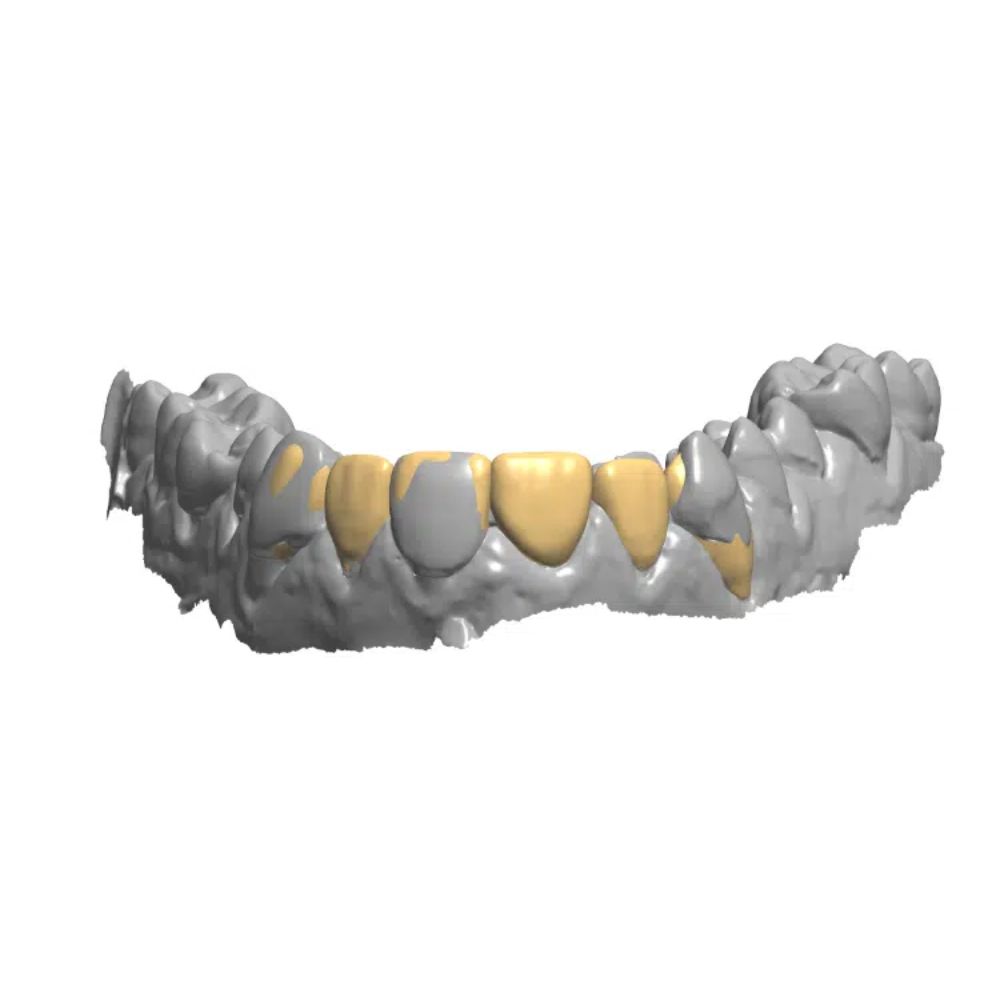 waxup-cad-digital Digital Diagnostic Wax-up CAD Design and Smile Design in Exocad