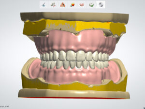 B2B outsourcing for digital denture design services utilizing Exocad and 3Shape software