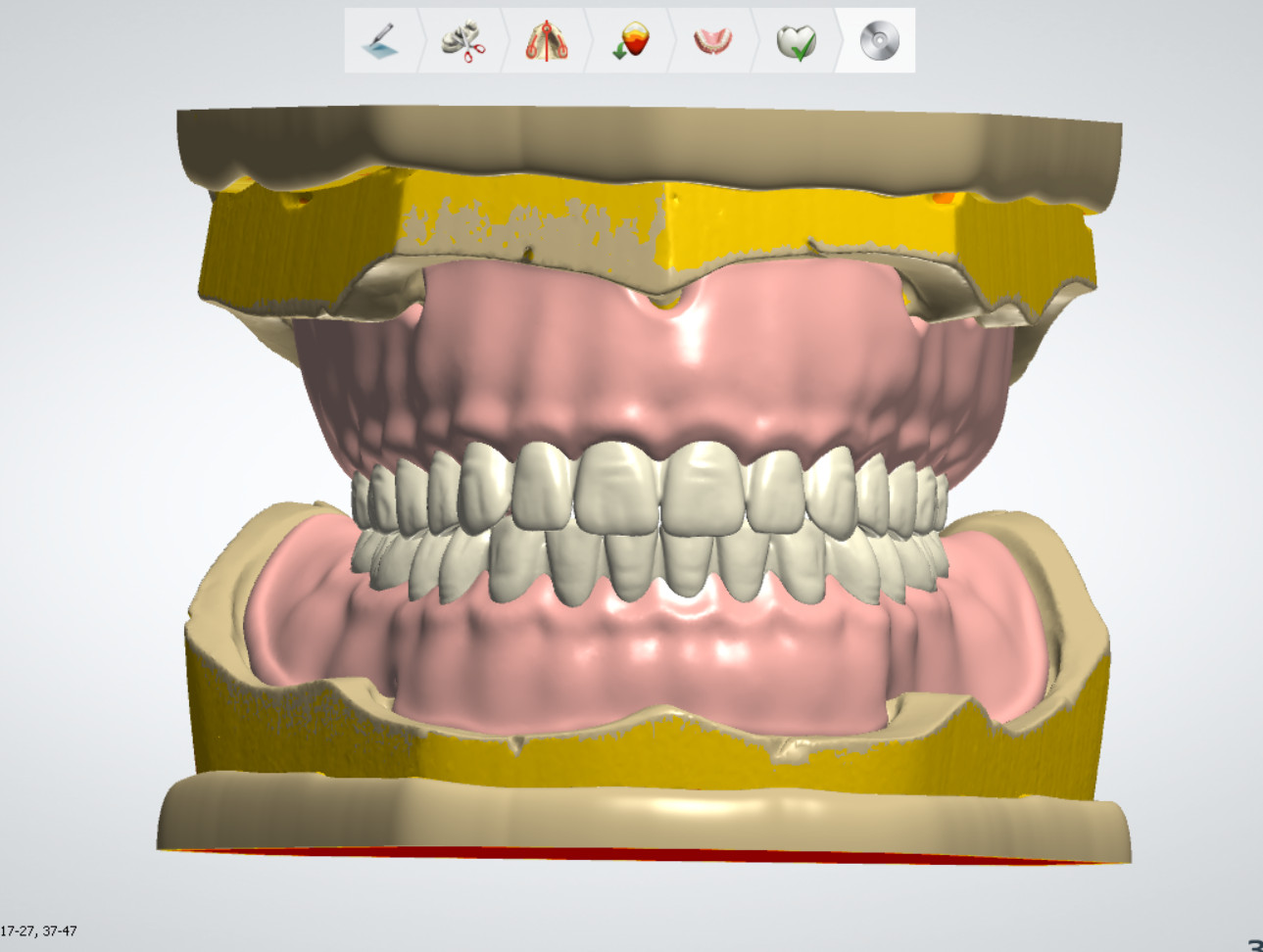 B2B outsourcing for digital denture design services utilizing Exocad and 3Shape software